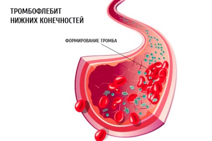 Este posibilă efectuarea chimioterapiei cu tromboflebită?