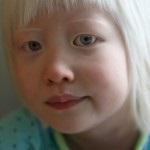 Mutația genei în albinism