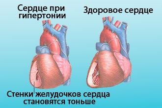 Hipertensiunea nervoasa - cum stresul creste tensiunea arteriala, cum sa tratezi boala