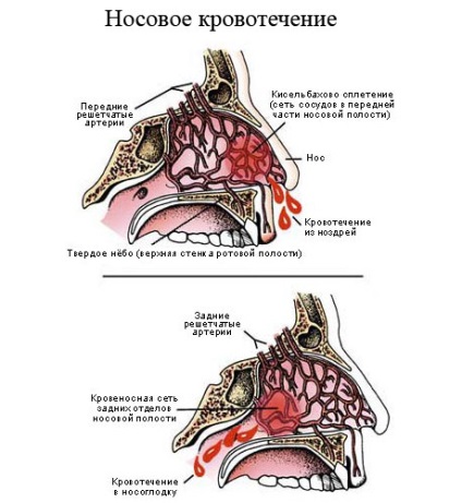 Sângerarea nazală la copii simptome, tratament, prevenire, cauze ale bolii
