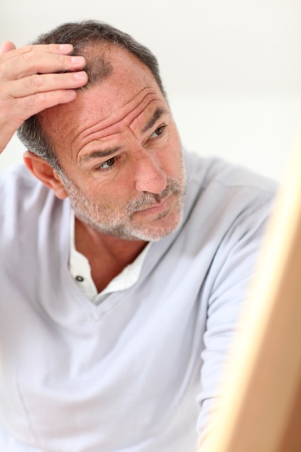 Alopecia la bărbați este adevărată și mituri
