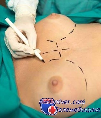 Complicațiile chirurgiei de mărire a sânilor