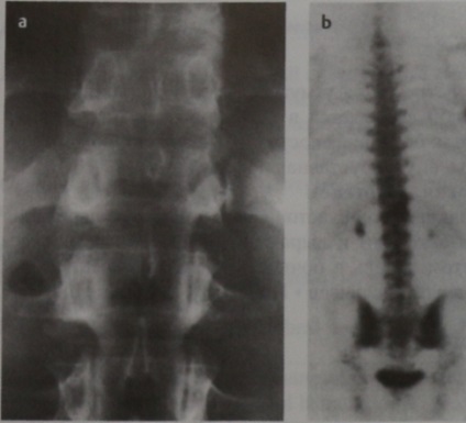 Tratamentul osteomului osteoid al osteomului osteomului osoase