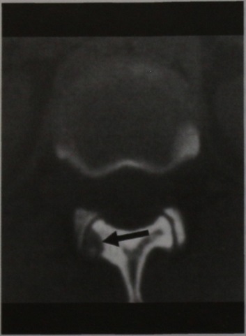 Tratamentul osteomului osteoid al osteomului osteomului osoase