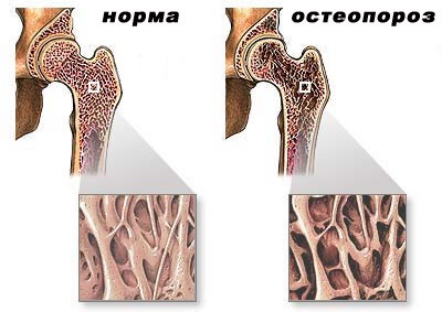 Osteoporoza - simptome, semne, tratament și metode de diagnostic