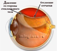 Detașarea retinei