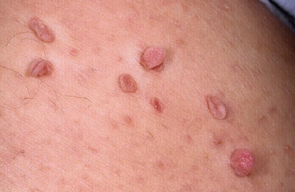 Boala de piele virală papilloma care apare atunci când imunitatea este redusă