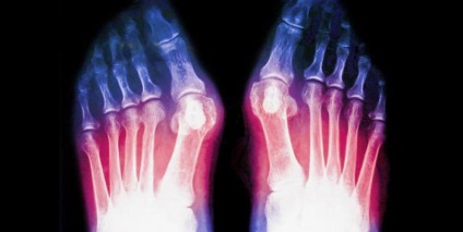 Fractura metatarsului osului metatarsal, diagnostic, reabilitare, prognostic