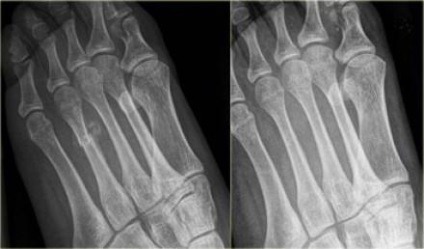 Fractura metatarsului osului metatarsal, diagnostic, reabilitare, prognostic