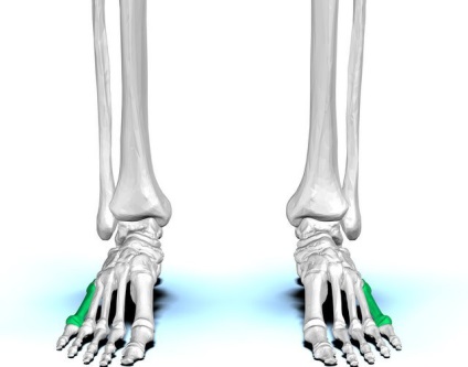 Fractura metatarsului osului metatarsal, diagnostic, reabilitare, prognostic