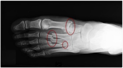 Fractura metatarsului osului metatarsal, diagnostic, reabilitare, prognostic