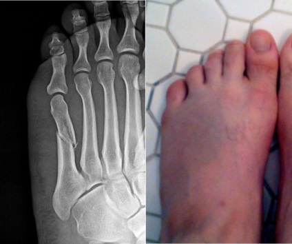 Fractura metatarsului osului metatarsal, diagnostic, reabilitare, prognostic