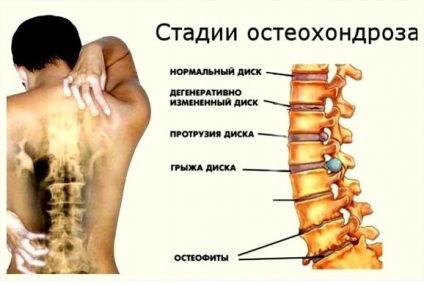 Leeches cu osteocondroză (tratament, hirudoterapie) cervical, lombar