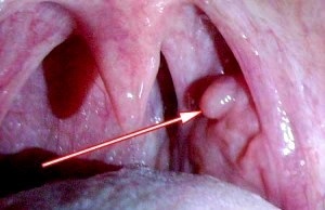 Polipi în gât, care sunt simptomele și ce să facă cu ei