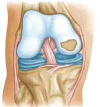 Cartilage károsodás, tünetek és kezelés