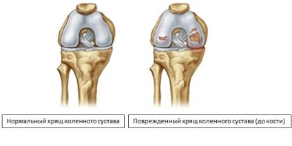 Deteriorarea cartilajului, simptomele și tratamentul
