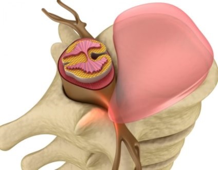 Tipuri de hernie vertebrală și tratament