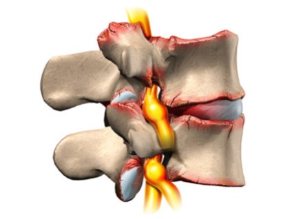 Tipuri de hernie vertebrală și tratament