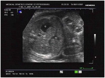 Diagnosticul prenatal cu ultrasunete a fătului
