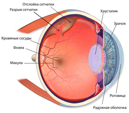 Ruperea cauzelor retinei oculare, simptome, tratament (intervenții chirurgicale)