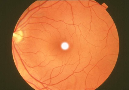 A szem retina okai, tünetei, kezelése (műtét)