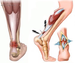 Reabilitarea după o rănire a tendonului Achilles, clinica Dr. Grigorenko