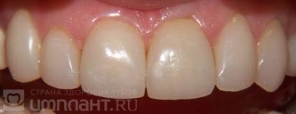Restaurarea dinților cum să corecteze aglomerarea
