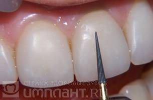 Restaurarea dinților cum să corecteze aglomerarea