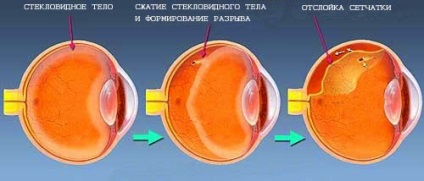 Simptomele detașării retinei la copii și adulți