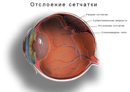 Simptomele detașării retinei la copii și adulți