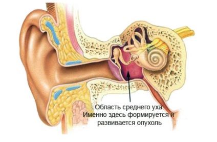 Simptomele cancerului de urechi, primele semne