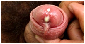 Tünetei gonorrhoea (gonorrhoea) a nők és a férfiak - tünetek, kezelés