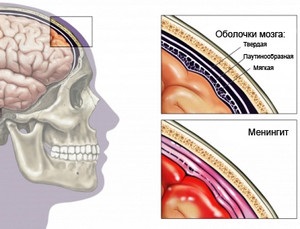 Simptomele meningitei virale și seroase la copii