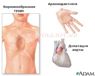 Tratamentul sindromului Marfan la Institutul de Ortopedie