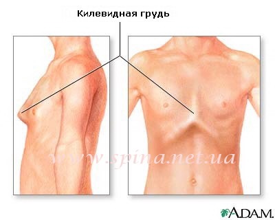 Tratamentul sindromului Marfan la Institutul de Ortopedie