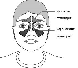 Sinuzita (sinuzită, frontalită, etmoidită, sfenoidită) - simptome, tratament