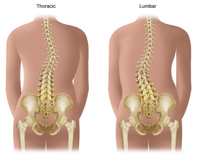 Scoliosis fő tünetei, ortopédiai tippek a scoliosis kezelésére és megelőzésére