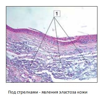 Слънчевата еластоза, причини, симптоми, лечение