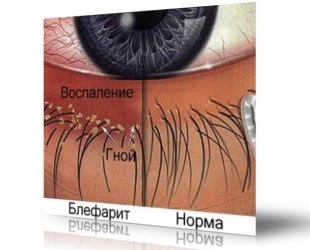 Lista bolilor oculare (boli oculare) diagnostic, tratament, prevenire