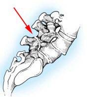 Spondylolysis és spondylolisthesis, traumatológia mindenki számára