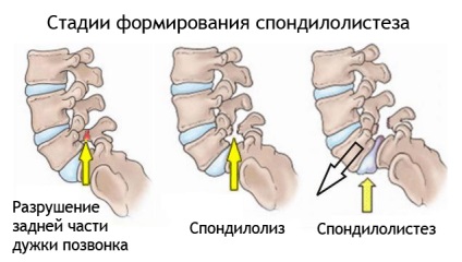 Spondiloliza vertebrei este un simptom, un tratament