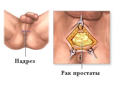 Metode de eliminare a cancerului de prostată