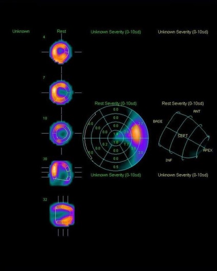 A myocardium szcintigráfiája (a szívizom perfúziós szcintigráfiája), a szív Moszkvában