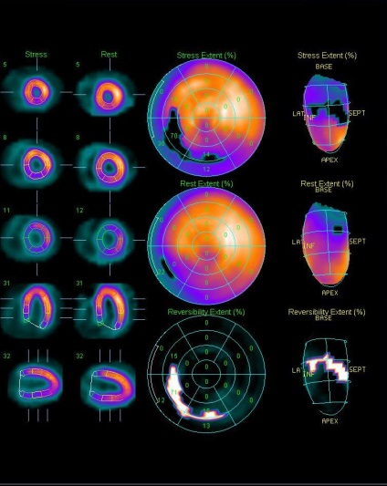 A myocardium szcintigráfiája (a szívizom perfúziós szcintigráfiája), a szív Moszkvában