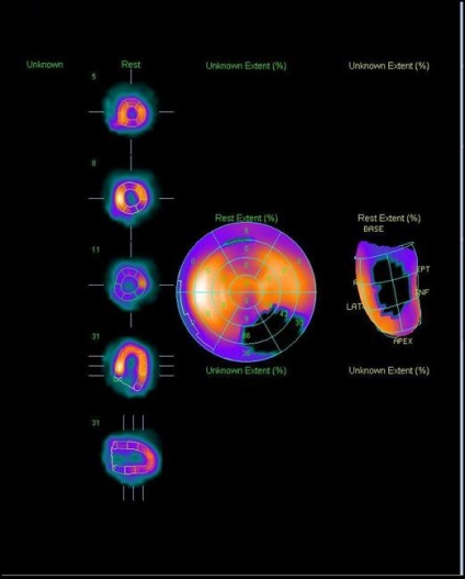 A myocardium szcintigráfiája (a szívizom perfúziós szcintigráfiája), a szív Moszkvában