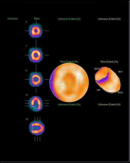 A myocardium szcintigráfiája (a szívizom perfúziós szcintigráfiája), a szív Moszkvában