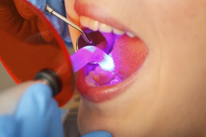Sigilii ușoare pe tehnologia dinților din față, diferențe față de cele convenționale