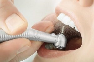 Sigilii ușoare pe tehnologia dinților din față, diferențe față de cele convenționale