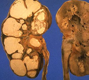Tuberculoza rinichilor și a cauzelor tractului urinar, căile de transmitere și simptomele bolii - dumneavoastră