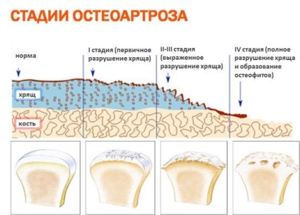 Sindromul spondilartrozei cervicale uncovertebrale, cum se trateaza